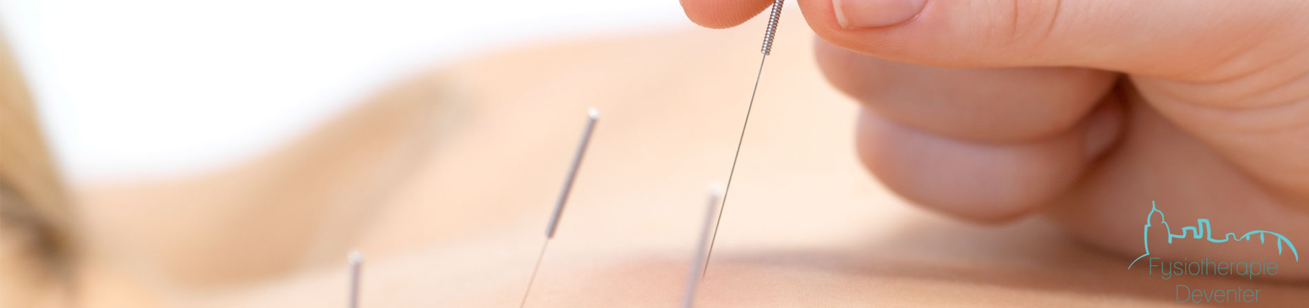 Dry needling